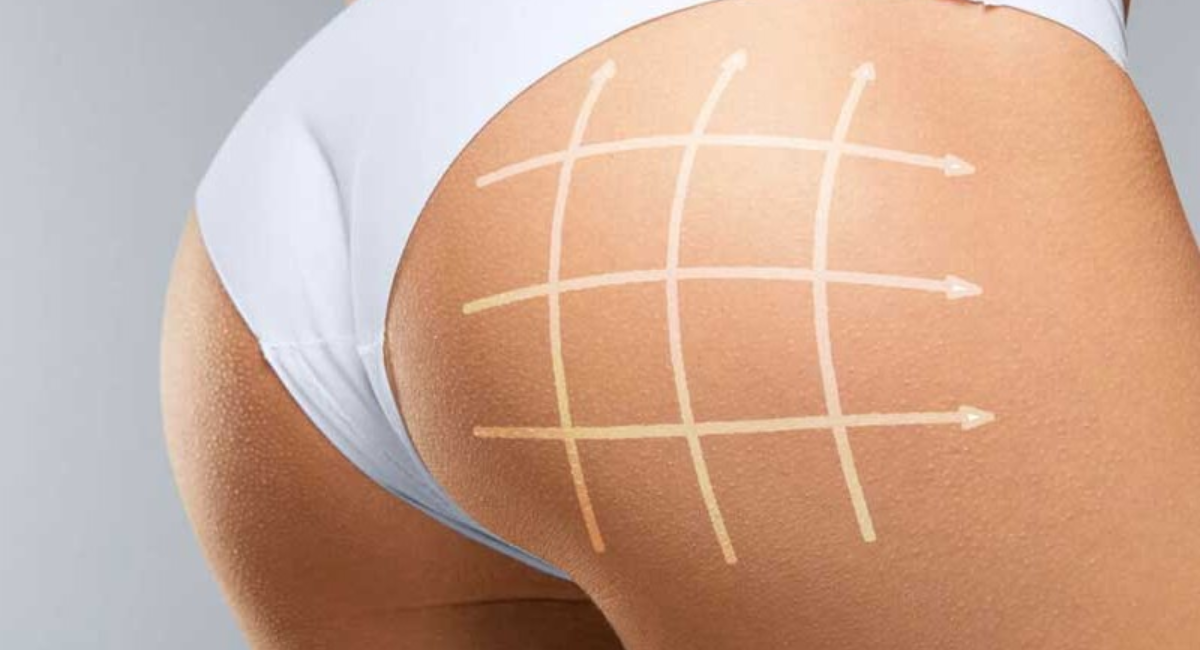 lipotransferencia