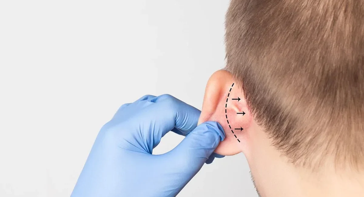 OTOPLASTÍA