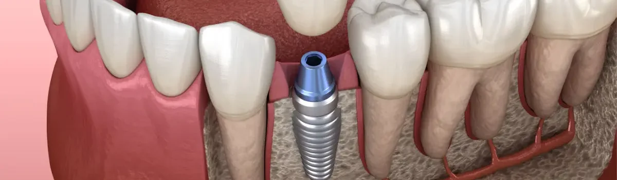osteointegracion-implantes-dentales-julian-saiz-00